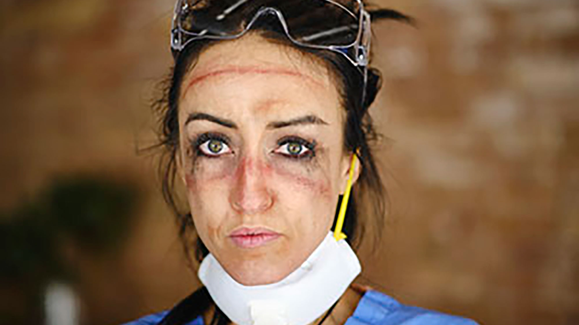 A woman nurse has bruising and discoloration on her face from wearing goggles and masks for long amounts of time.