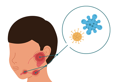 A graphic drawing of a person with inflamed salivary glands injected with viruses.
